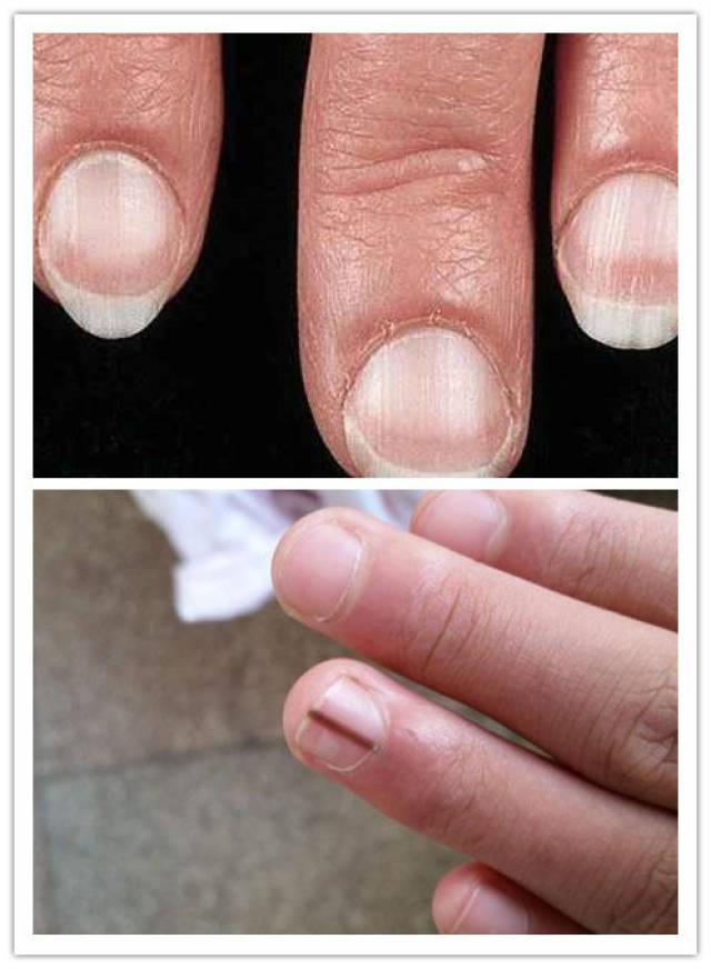 横纹会在饮食不规律,营养不良的时候出现在指甲上.