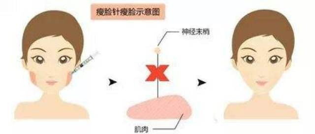 瘦脸针是怎么瘦脸的