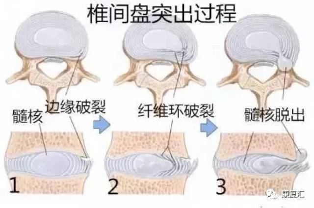 椎间盘突出过程