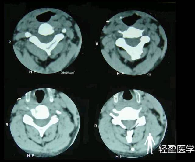 椎无叩痛,棘上棘间无压痛;椎旁,左侧c2横突,双侧胸锁乳突肌及斜方肌