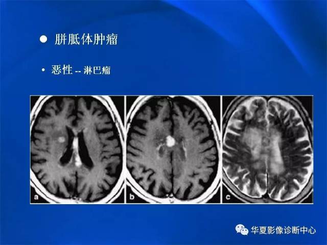 胼胝体解剖及各种病变的影像学表现