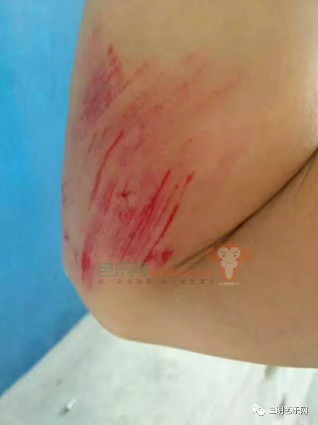 注意三明这个"坑"!一女子骑车经过时摔伤出血