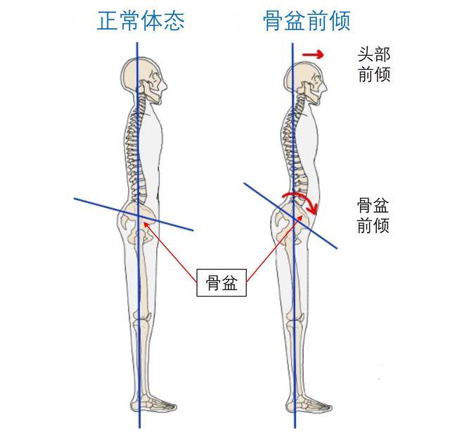 都是骨盆前倾惹的祸!