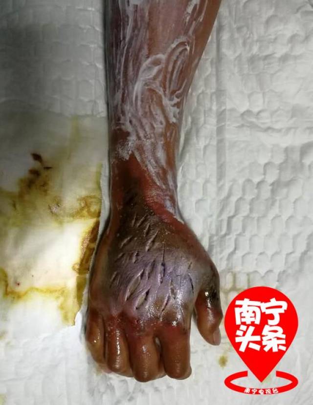 上方图片中是一名被毒蛇咬伤的病人的手,肿胀发黑可