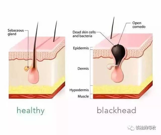 螨虫破坏毛囊,皮脂腺内环境导致鼻翼的黑头不断增多,造成毛囊堵塞