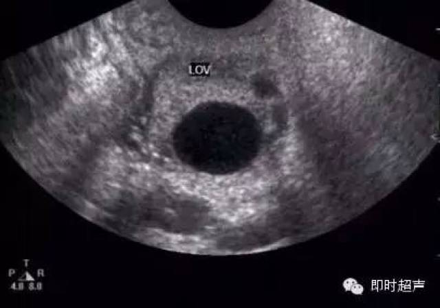 正常成熟的优势卵泡的声像图
