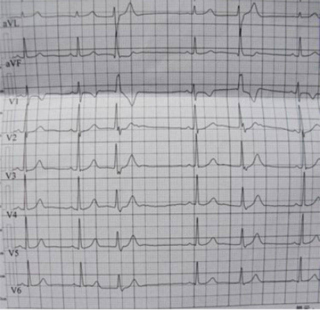 窦性心律不齐在心电图上的表现 窦性心律失常,包括:窦性心动过速,窦