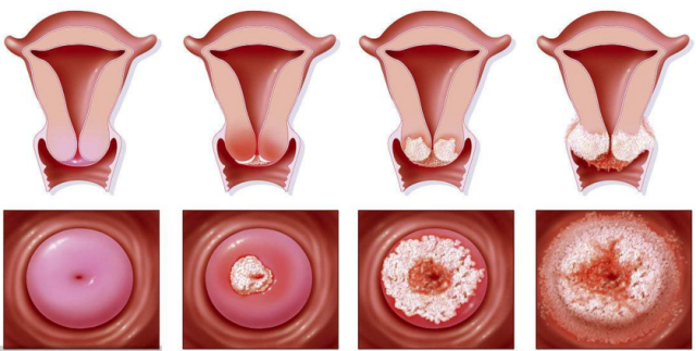 宫颈癌高危人群,需警惕的宫颈癌发病前的6个征兆