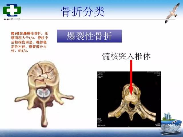 腰椎爆裂性骨折护理查房