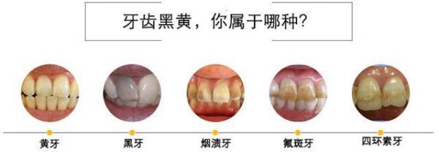 为什么你天天刷牙,牙齿还是比别人黄?