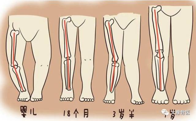 儿童x型腿和o型腿都是异常的吗?