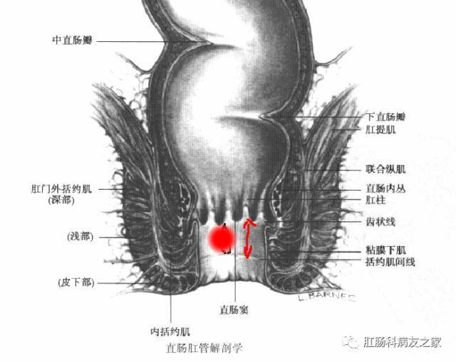 肛裂是怎么回事?