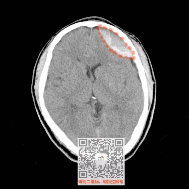 ④ 急性硬膜外血肿 ct特点: 梭形或双凸形白色影 贴近颅骨的是 硬