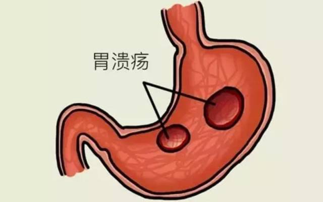 小心,"胃溃疡离胃癌"最近"胃溃疡的三种自检"方法与饮食调理