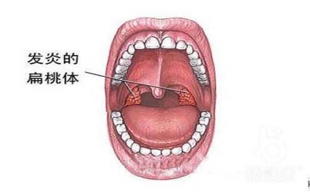 扁桃体发炎一定要摘除么?不!