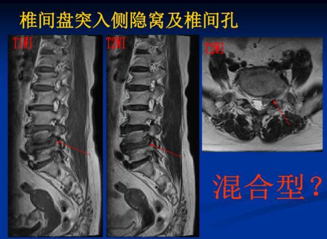 腰椎间盘突出症的影像学诊断和治疗