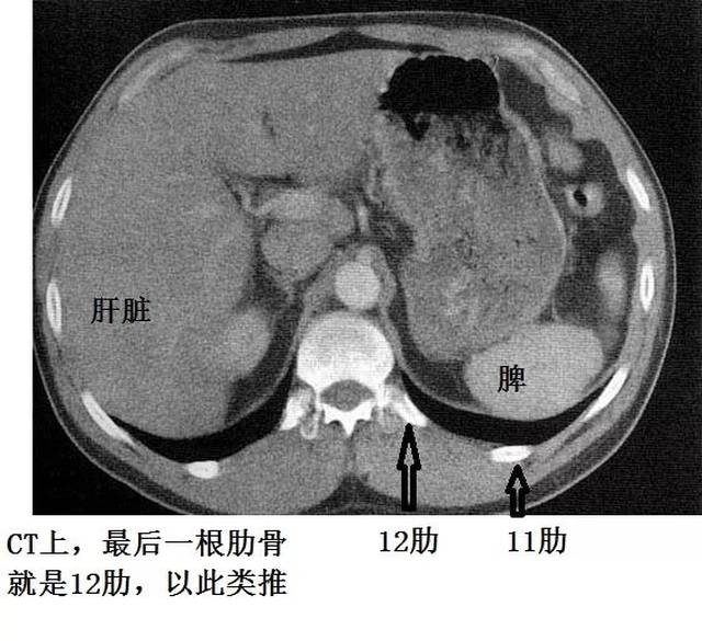 史上最全胸腔穿刺总结!快收藏