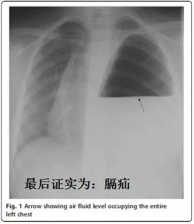 上面的胸片,乍一看,液气胸,结果是膈疝.