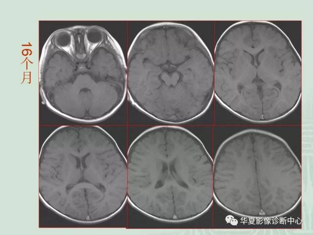 正常小儿颅脑的磁共振表现