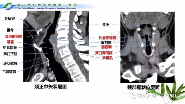 喉部解剖及t分期影像诊断