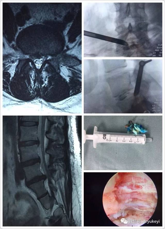 8mm小口,如何拯救被腰椎间盘突出压迫的神经根