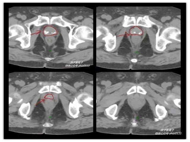 前列腺钙化是男性盆腔影像学检查非常常见阳性发现.