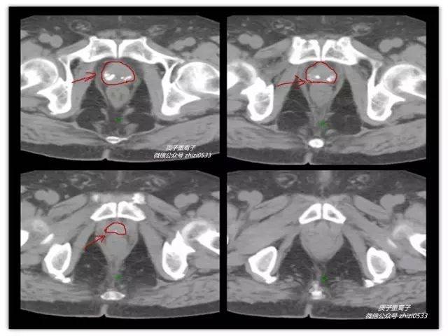 很多男性做了盆腔ct,看到报告里提到前列腺有钙化,往往很紧张,不知所