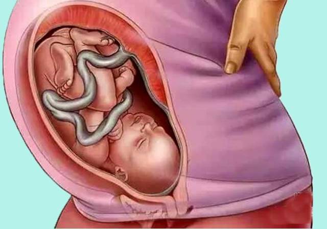 分析:前置胎盘是否能够顺产关键要看前置的类型,然后要看胎儿的情况