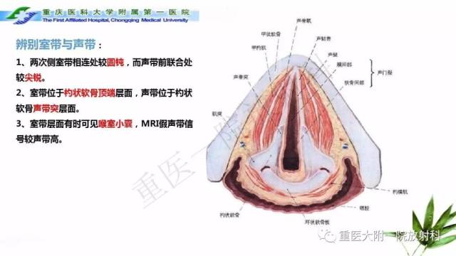 喉部解剖及t分期影像诊断