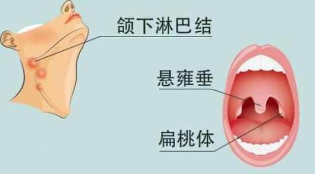 有不少儿童因为体质问题经常会出现扁桃体发炎的病情,严重的甚至需要