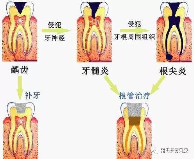 急性牙髓炎