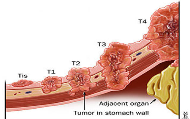 "胃癌从早期到晚期"大概需要经历多长时间