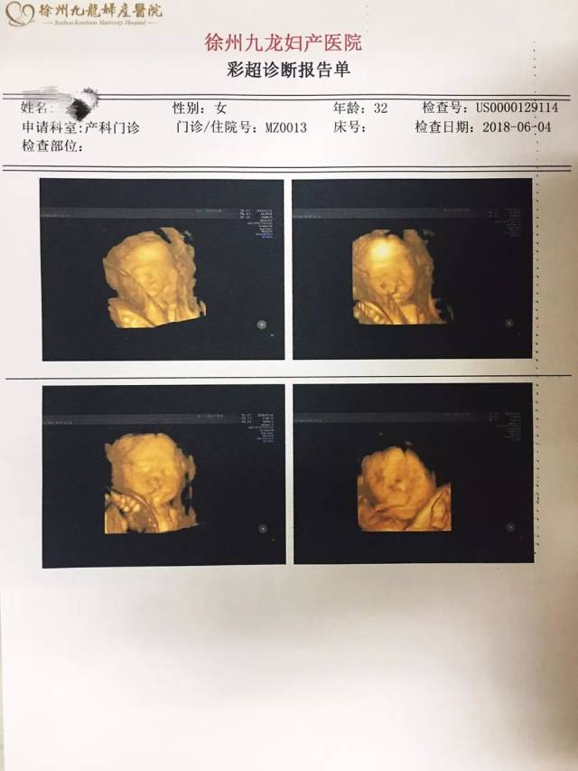 双胎宝妈21周做四维彩超,筛查出一名胎儿为"唇腭裂"