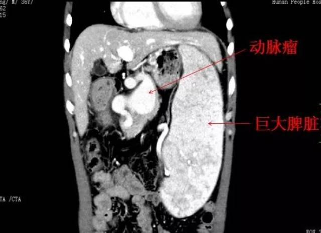 脾脏上长橙子大动脉瘤,成功切除还省下一辆"奔驰"车