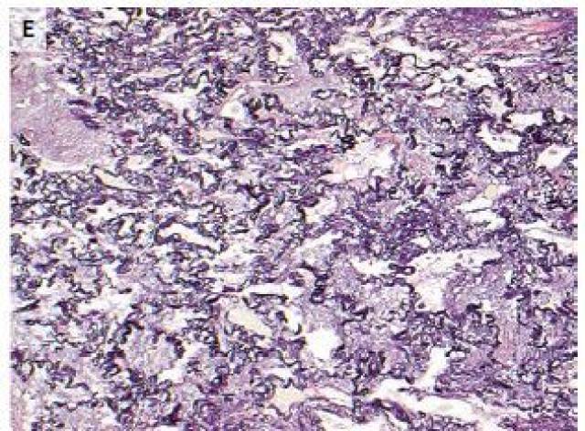 最终诊断:特发性胸膜肺弹力纤维增生症(idiopathic pleuroparenchymal