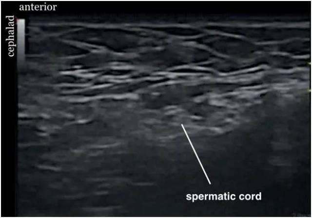 cord 精索 cephalad 头侧  anterior 前方      注射后精索超声图像