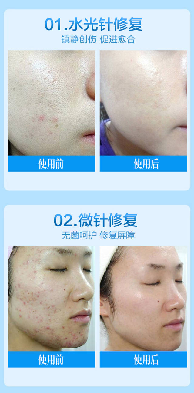 无针水光副作用不容忽视 做了摩皱,奢美人怎么样修复