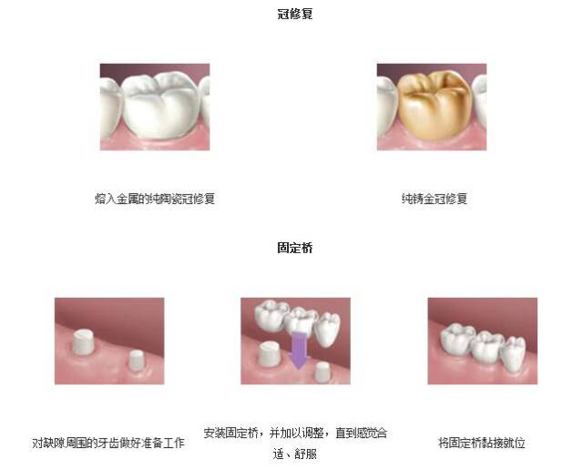 冠修复与固定桥能够使用多长时间?