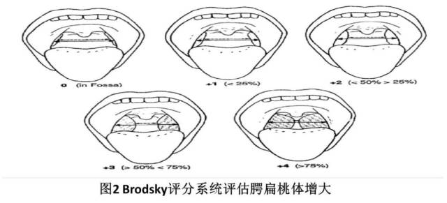 小编说:患儿扁桃体肿大,按照brodsky分级,进行评分,这道题是记忆题.