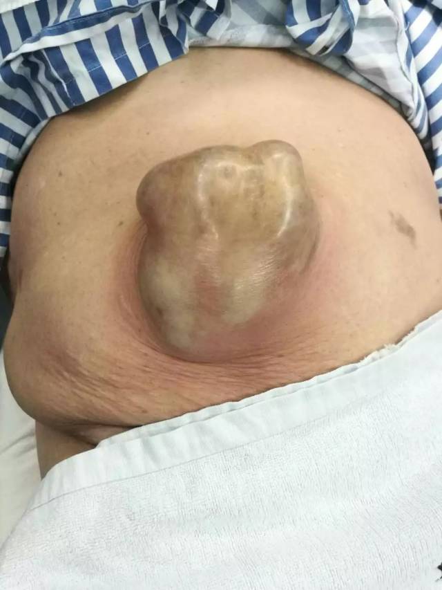 杭州大妈肚子鼓了个香瓜大的包,竟然是肠子卡在肚脐上了!