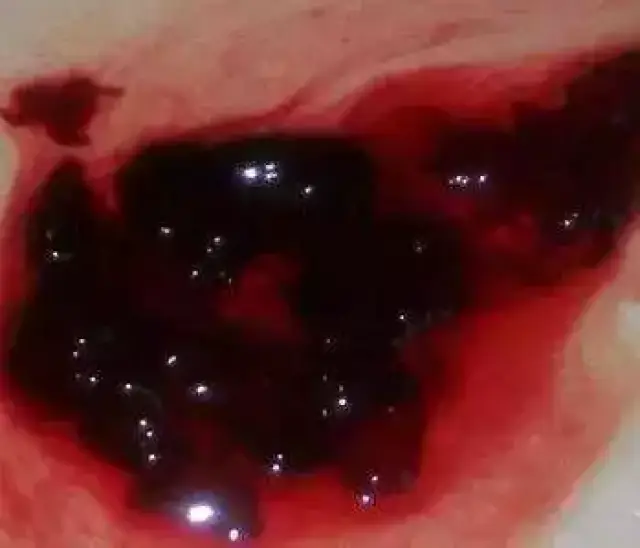 郑州新世纪女子医院专家介绍,正常月经血中含有少量的子宫内膜碎片