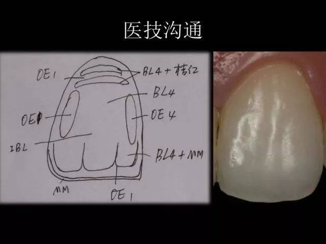 对牙齿不同部位进行比色,记录每一个部分需要的特殊效果值