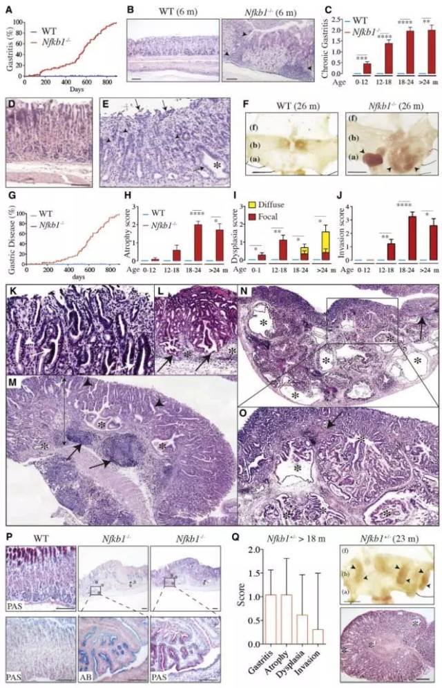 nf-κb1缺陷小鼠易发展成肠型胃腺癌