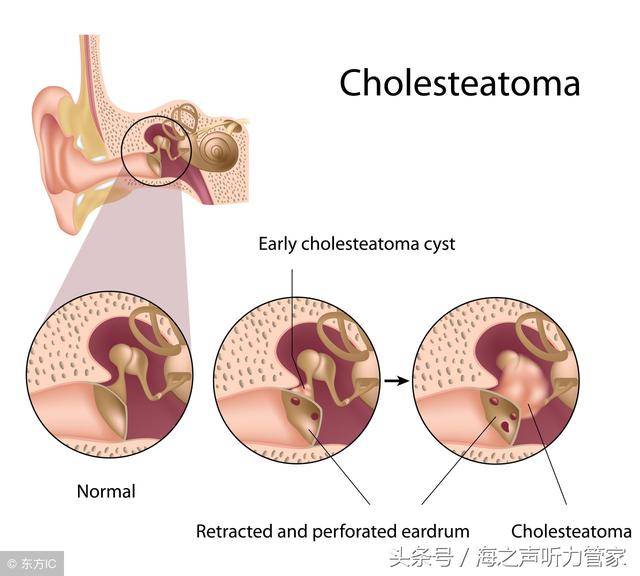 胆脂瘤型中耳炎术后一定要按期复查