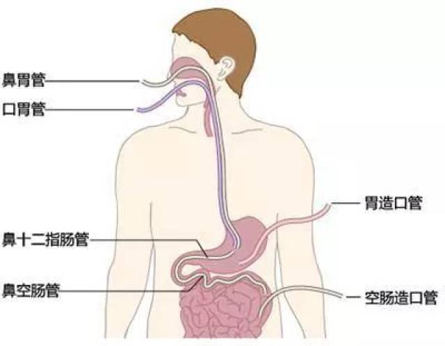 宁津县中医院首例床旁鼻肠管置管置入成功