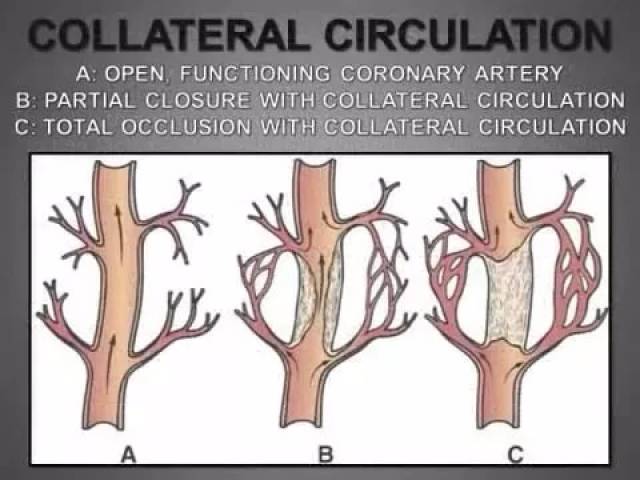 让堵塞的心脏血管重焕"生机",心内科专家教你建立侧支循环!