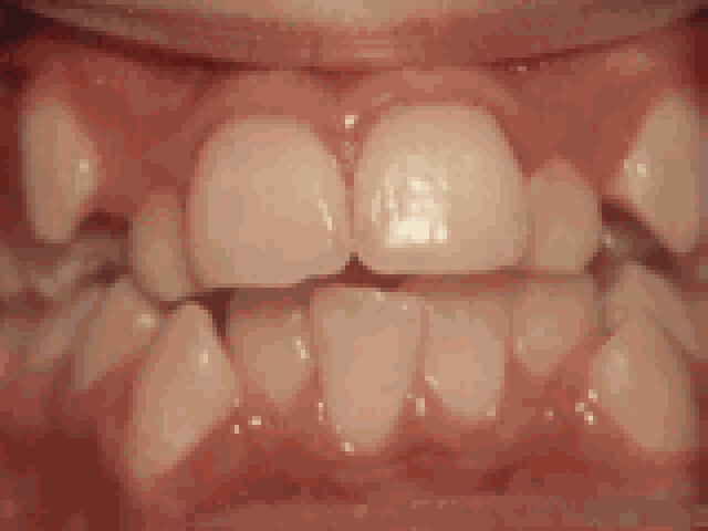 第五种 开合,即使闭嘴,上下牙齿也不接触,留出空隙,经过矫正后的