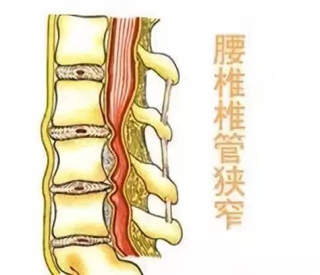 腰椎管狭窄症是指由于先天或后天因素所致的腰椎椎管或椎间孔狭窄