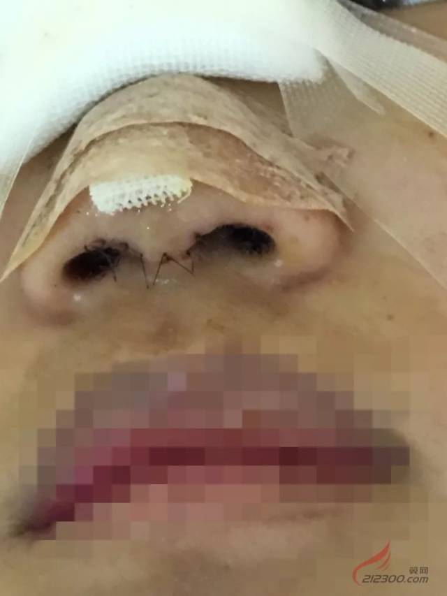 鼻头感染,鼻头取了就可以然后给我鼻头伤口缝针.
