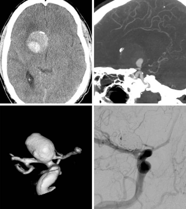 前循环动脉瘤:夹闭或栓塞? | the neurosurgical atlas全文翻译